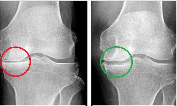 Depanten restored the mobility of my joints