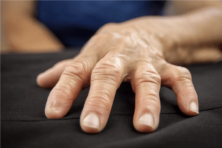 In gout, the knuckles become warm to the touch, swollen and painful. 