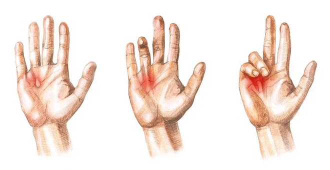 Stages of Dupuytren's contracture - inability to straighten the fingers