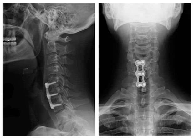 Picture after the treatment of vertebrae