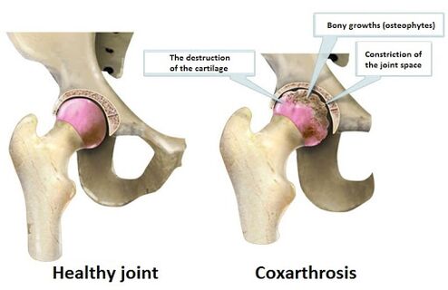 Healthy joint affected by coxarthrosis becomes