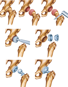 Installing an endoprosthesis