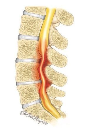 With osteochondrosis of the chest, compression of the spinal canal occurs