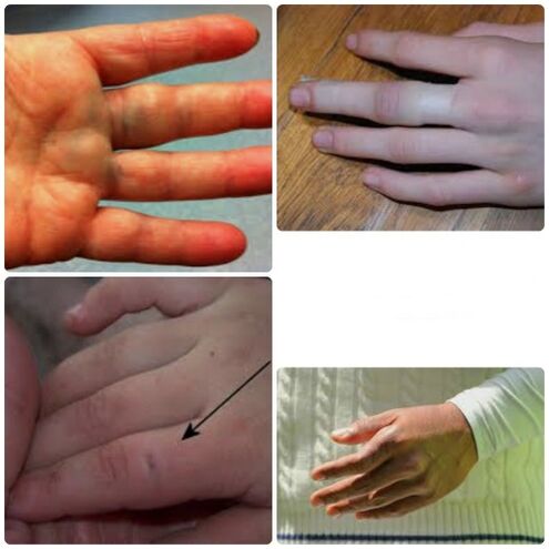 Finger bruises and fractures are characterized by joint pain and swelling