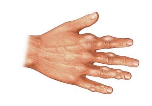 Soft tissue uric acid crystal deposition in gout