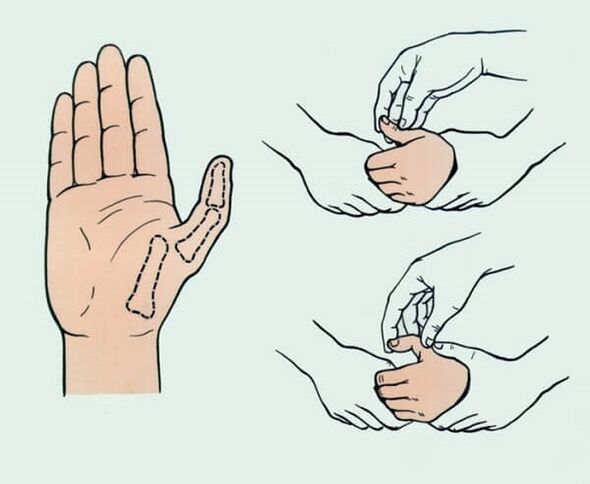 Sprained finger reduction needed to eliminate joint pain