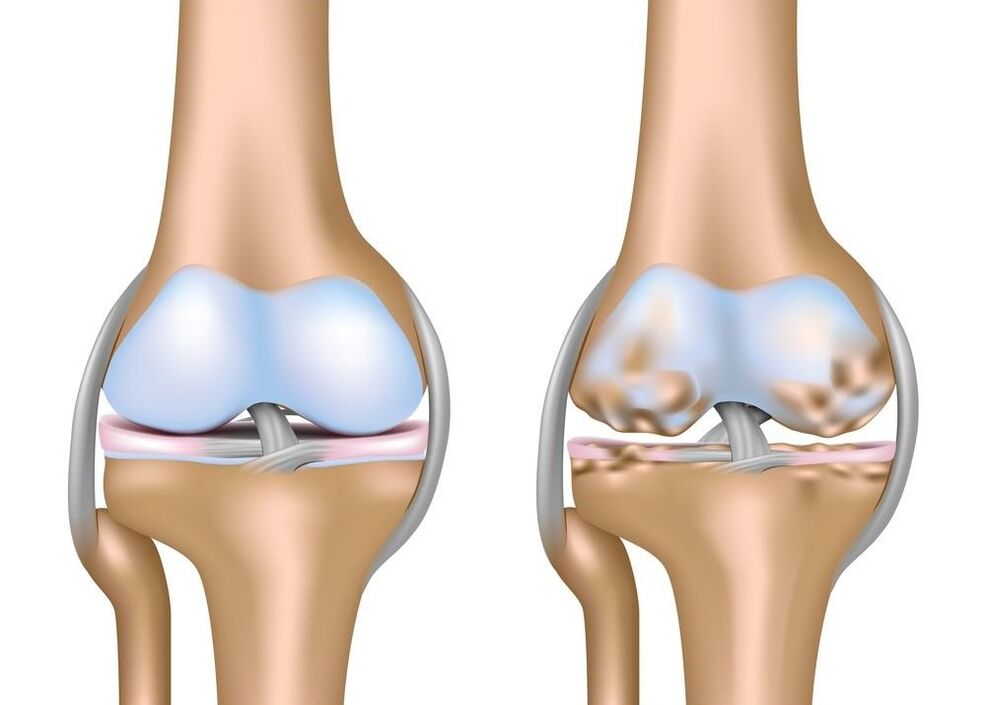 exacerbation of arthrosis of the joints