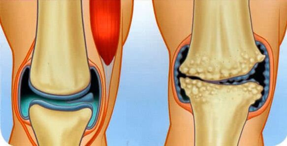 healthy joint and osteoarthritis of the joint