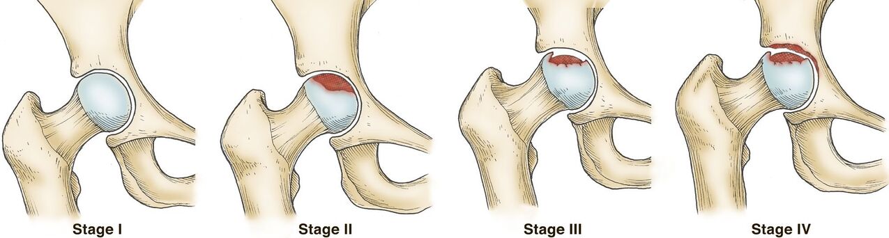 Degrees of osteoarthritis of the hip