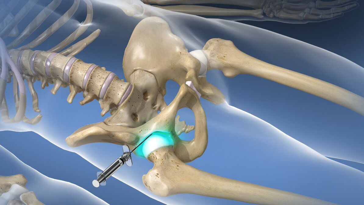 Intra-articular blockade for severe pain accompanying osteoarthritis