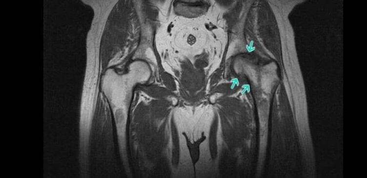 MRI osteoarthritis of the hip