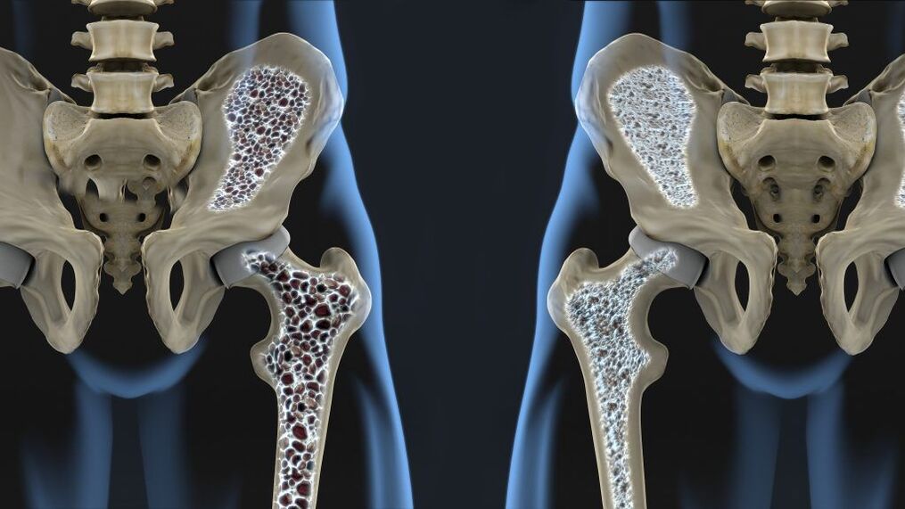 Osteoporosis is the cause of hip fracture and hip osteoarthritis