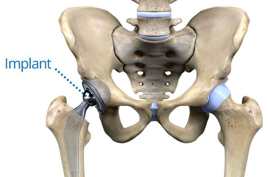 Total arthroplasty of the hip joint for osteoarthritis